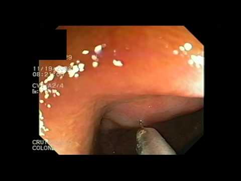 Tubular Adenoma Là Gì - Tubular Adenoma in Cecum