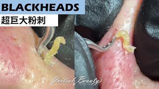 超大超深黑頭粉刺( blackheads ) - Taiwan Tainan台南清粉刺最乾淨