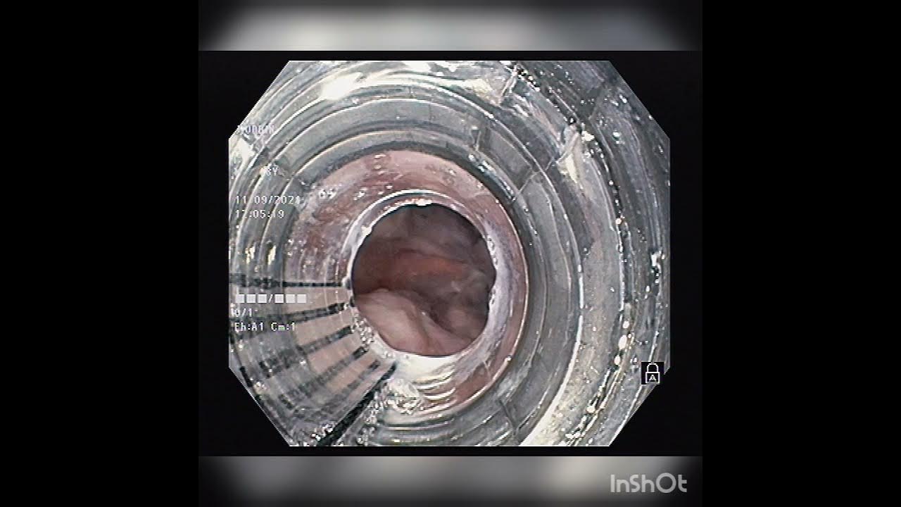 Esophageal variceal banding for grade 3 esophageal varices youtube
