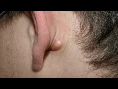 Boule derrière l'oreille que faire ?