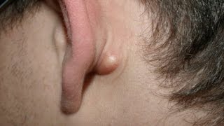 Boule Derriere L Oreille Que Faire Mission Sante