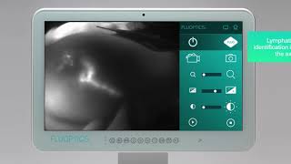 FLUOBEAM® IN ACTION - Lymphatic surgery - Sentinel node biopsy