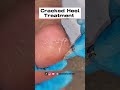 Remove Cracked Heels - So satisfying, 6 mins Cracked heel treatment by foot doctor miss foot fixer