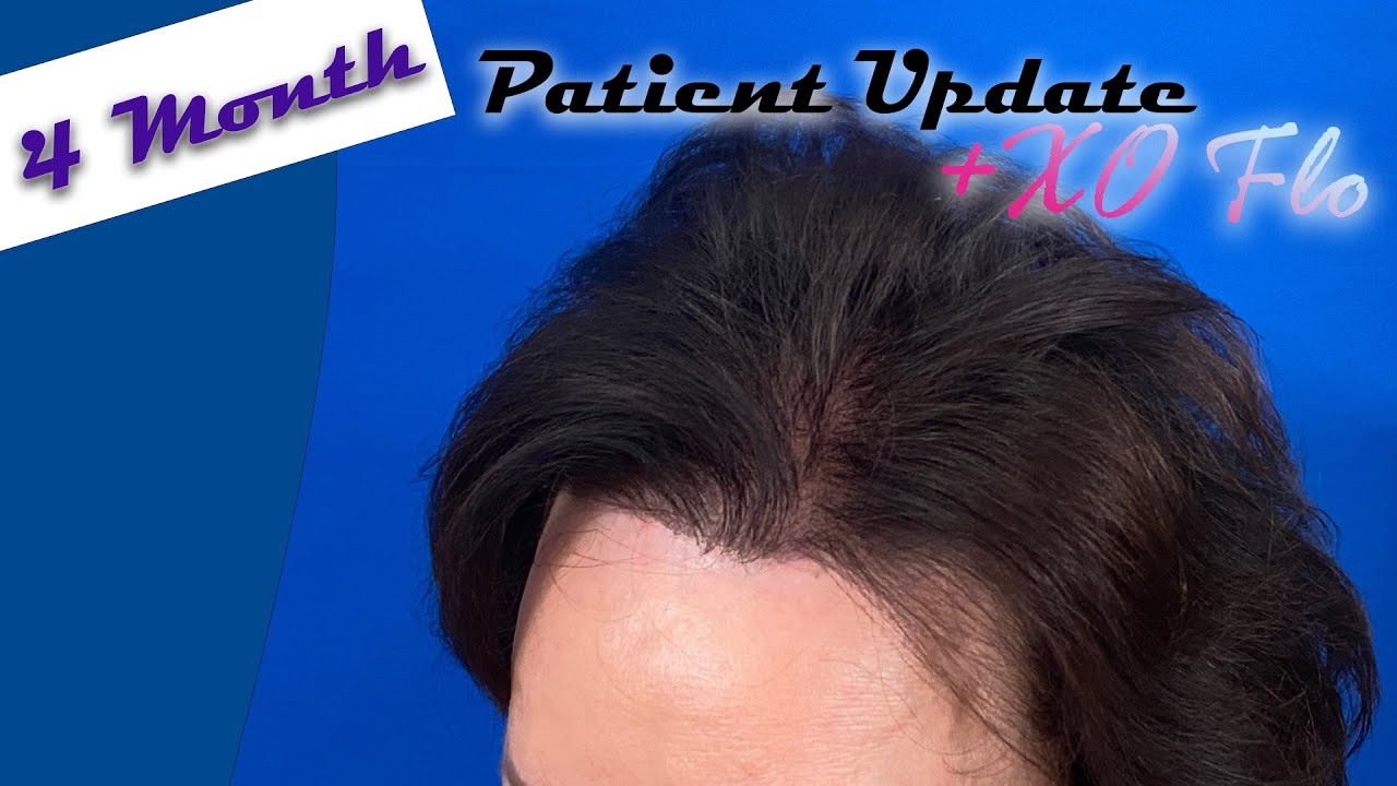 Female Hair Loss Treatment - No Surgery Patient Update - YouTube