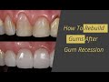 Gum Recession Cure - How to Rebuild Gums
