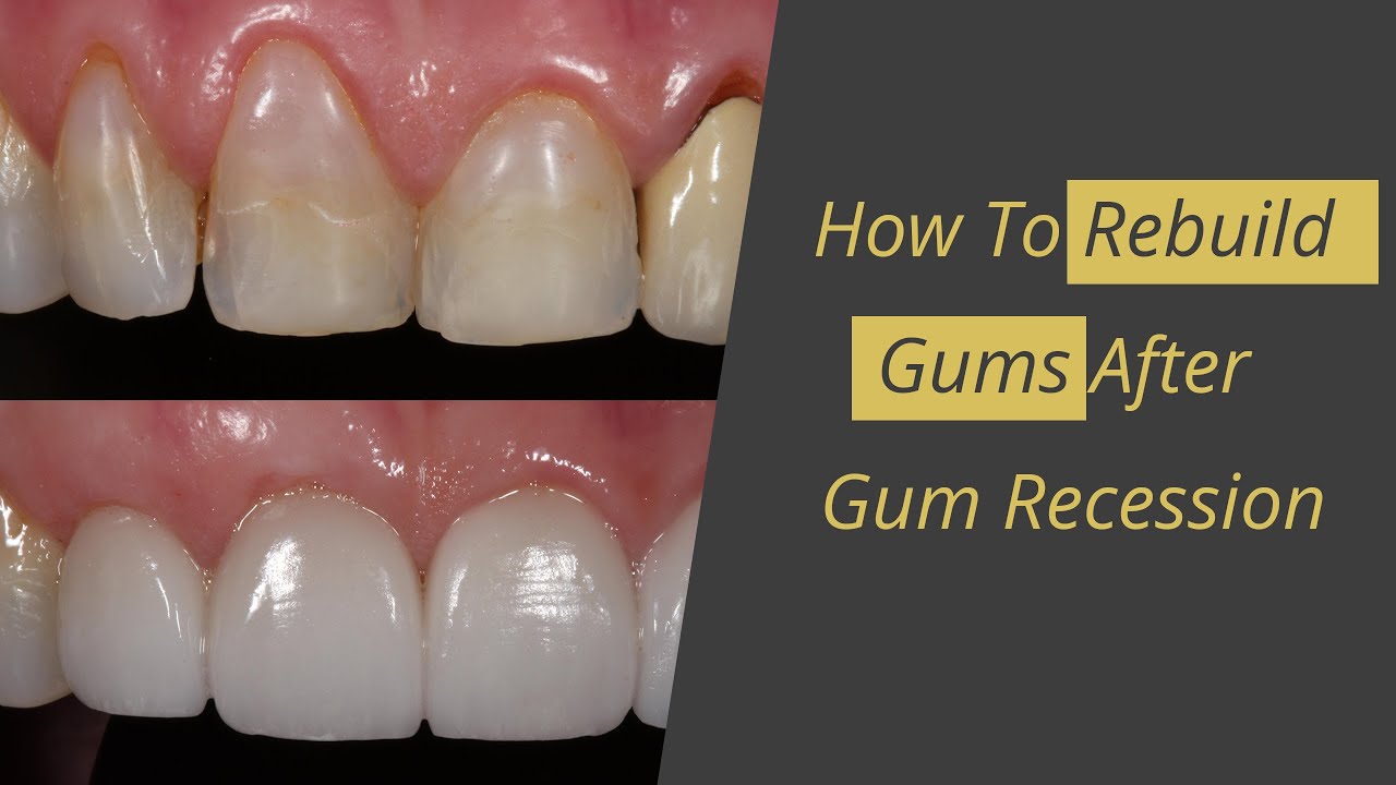 How To Whiten Teeth With Receding Gums