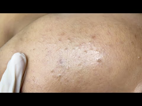 Blackhead, Acne | Mụn Đầu Đen, Mụn Trứng Cá - SacDepSpa#326