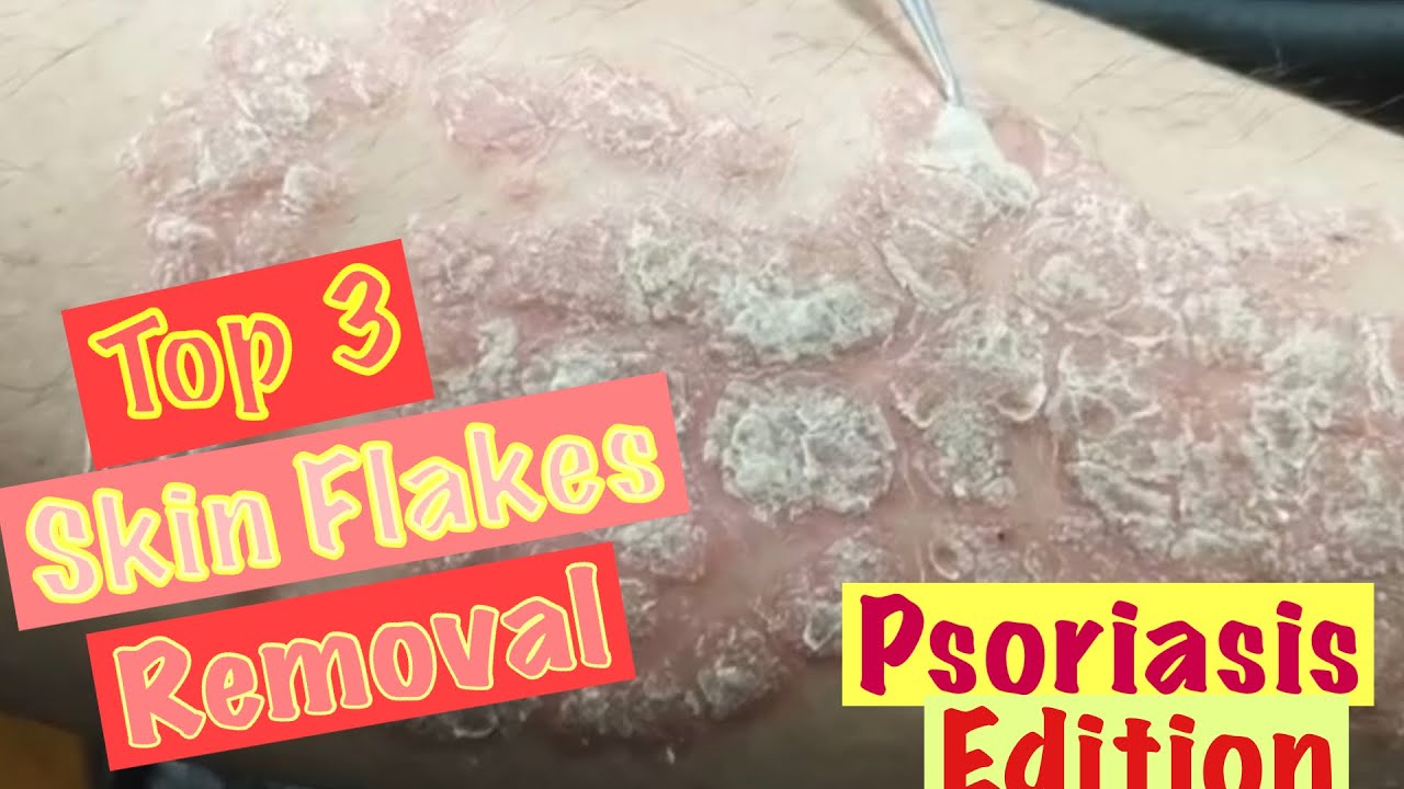 Relaxing Top3 Skin Flakes Removal Psoriasis Edition YouTube