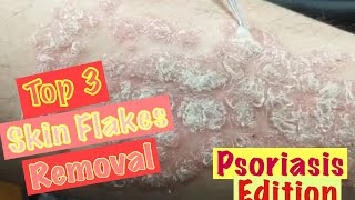 Relaxing Top3 Skin Flakes Removal || Psoriasis Edition