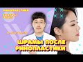 ШРАМЫ ПОСЛЕ РИНОПЛАСТИКИ | Dr. Kim Sung Sik