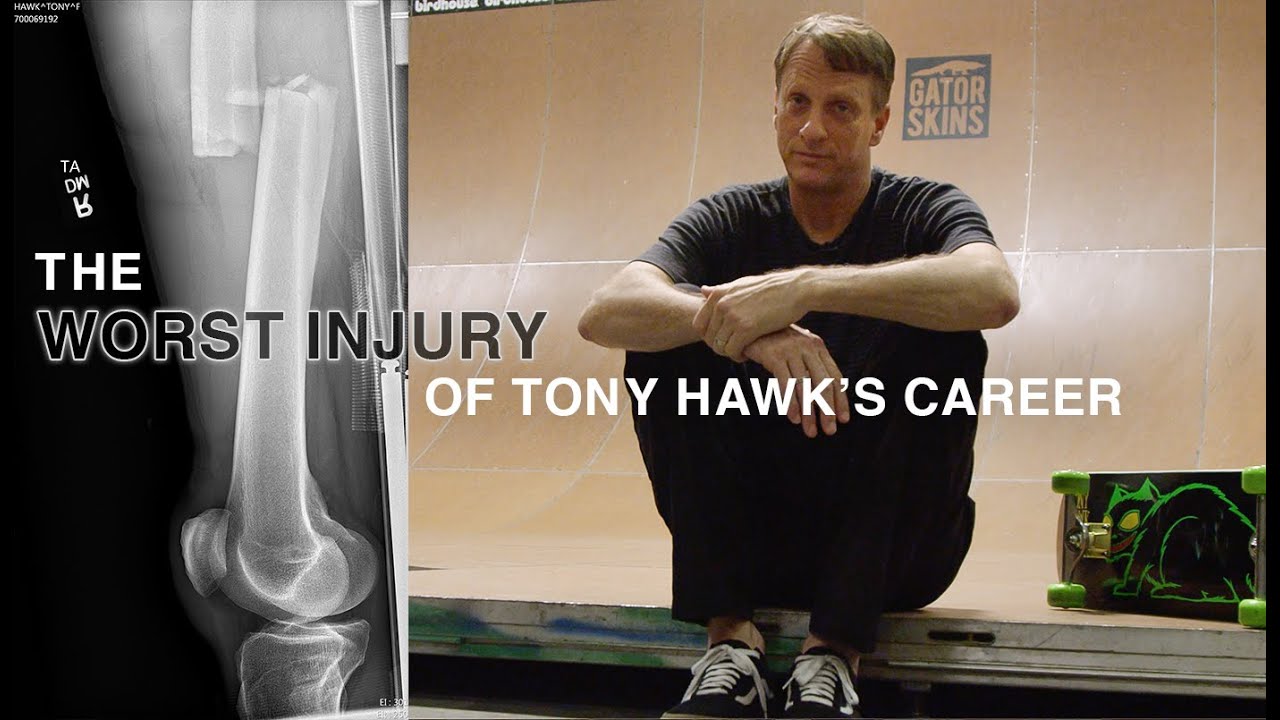 Tony Hawk breaks his leg but isn't retiring