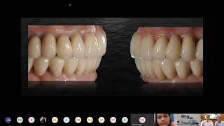 Webinar: Implant dentistry. Digital workflows   Dr. G Ciabattoni &amp; Dr. A Acocella | Alpha-Bio Tec