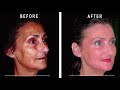 Non surgical 3D lifting with the Deep Peelings Lip & Eyelid and Easy Phen Light