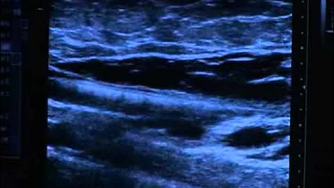 VNUS Closure Procedure - Patient Education Video