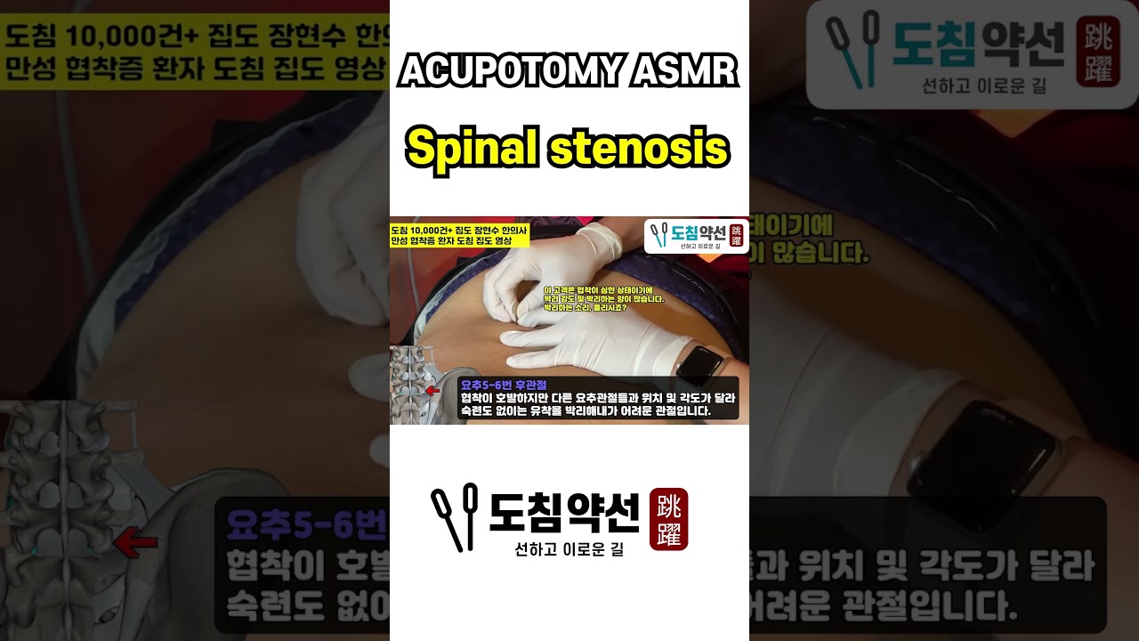 [Acupotomy Asmr] Spinal stenosis