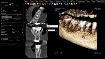 Invivo 6 Endo Workflow