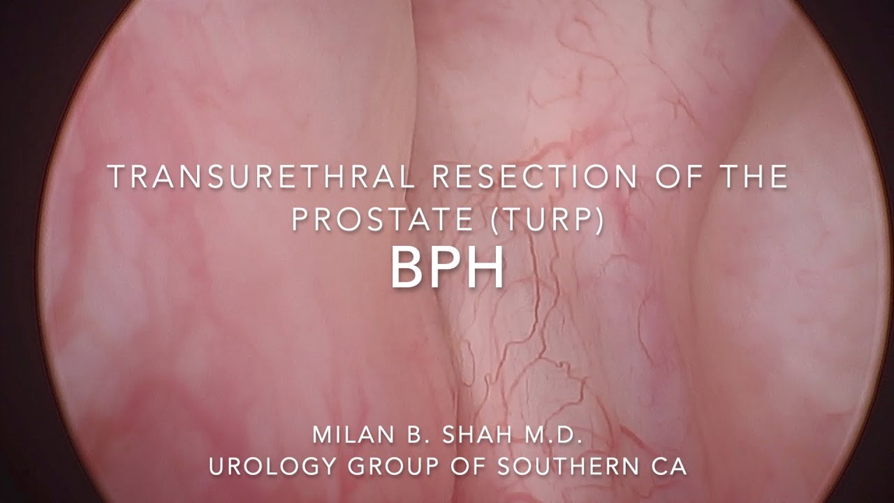 Bph Transurethral Resection Of The Prostate Turp Youtube