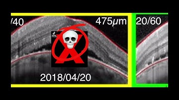 IA x real life dome SHAPED MACULA