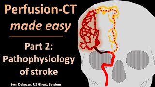 Perfusion CT made easy   part 2  pathophysiology of acute ischemic stroke