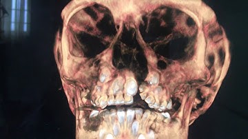 Cleft Alveolus Accurate Diagnosis with Cone Beam CT Scan - Dr Richardson