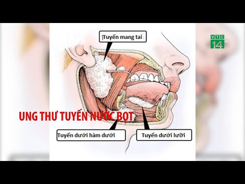 Ung thư tuyến nước bọt| VTC14