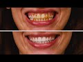 Denti bianchi e sorriso smagliante – 9 segreti di bellezza che funzionano davvero