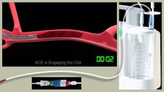 MedArt Example 3D Animation - Penumbra ACE Video Highlights 2016
