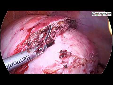 Laparoscopic Myomectomy for Intramural Fibroid