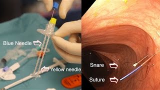 Endoscopic colostomy (World Cup of Endoscopy, DDW 2017)