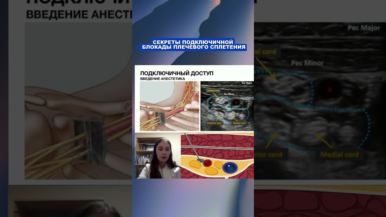 Секреты подключичной блокады: УЗИ-навигация. Плечевое сплетение.