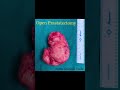 82-year-old with 250cc prostate treated by open prostatectomy. #DrPrakashSankapal #Ulwe #urologist