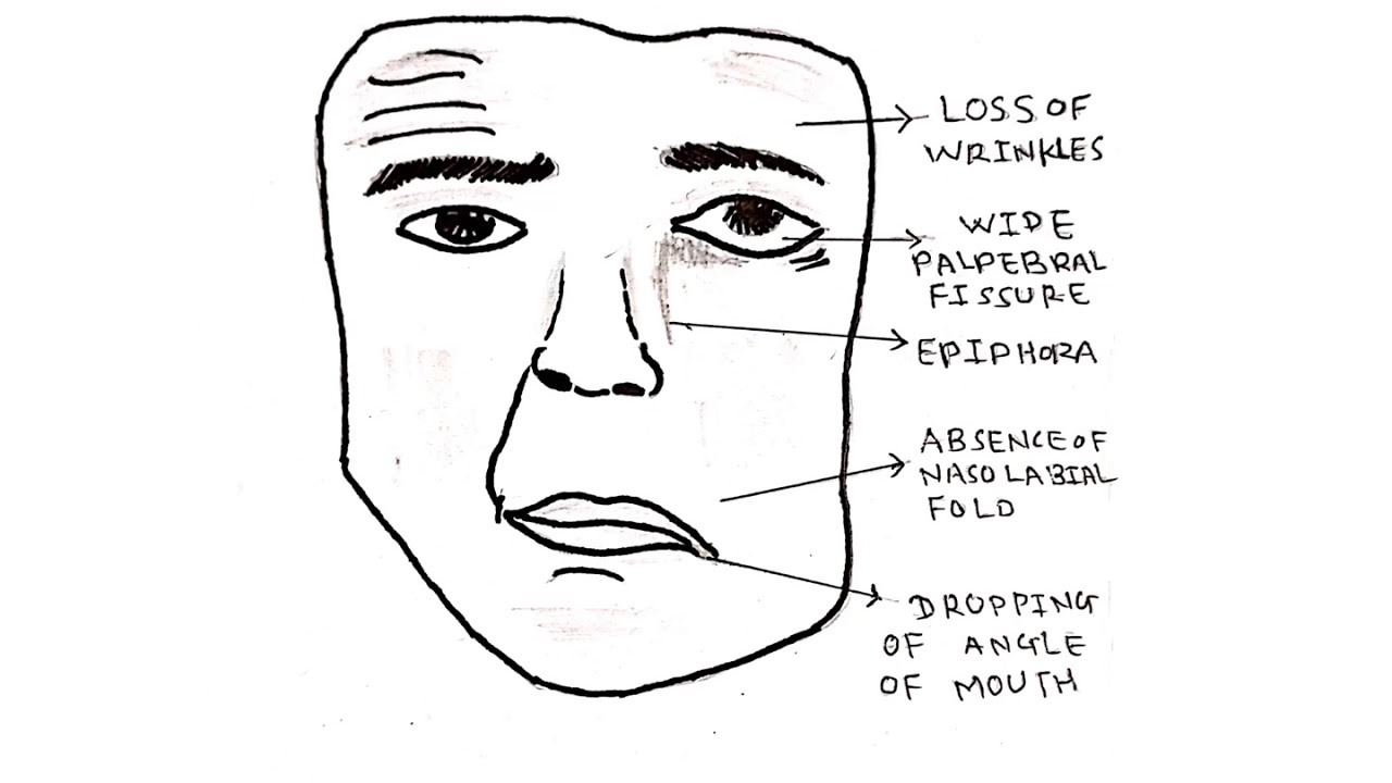 Bell's palsy Facial nerve palsy ENT Lecture Series YouTube