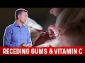 Receding Gums and Vitamin C Explained By Dr.Berg