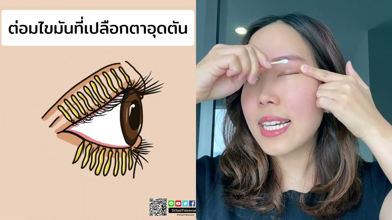 [อันเก่าแล้ว มีใหม่กว่านี้2025] เทคนิค 3 ขั้นตอน ดูแลต่อมไขมันเปลือกตาอุดตัน MGD ให้ง่ายขึ้นกว่าเดิม