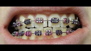 Dressing-Up With Fake Braces