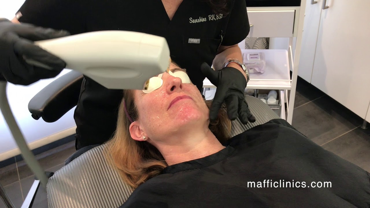 Maffi Clinics: BBL Photofacial