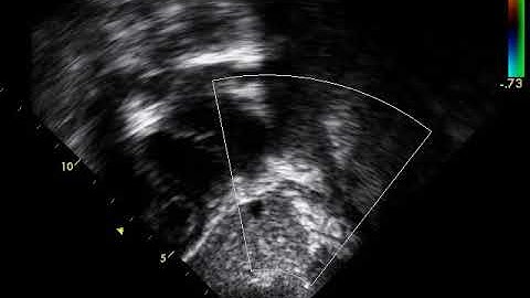 IVC interrupted, azygous cont