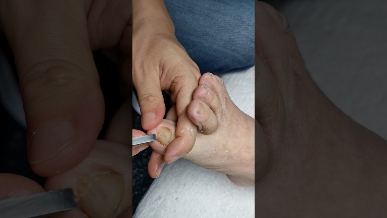 Ingrown nail treatment YouTube