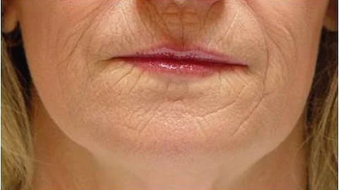 DermTV - How to Treat Smokers Lines [DermTV.com Epi #292]