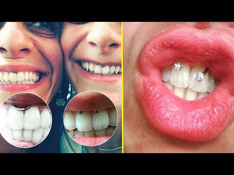 Vidéo: Tout Sur Le Perçage Des Dents: Procédure, Images, Complications