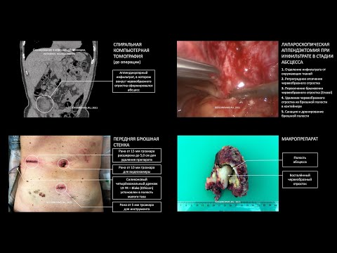 Video: Apendikularna Infiltracija - Vzroki, Simptomi, Diagnoza In Zdravljenje Apendikularnega Infiltrata