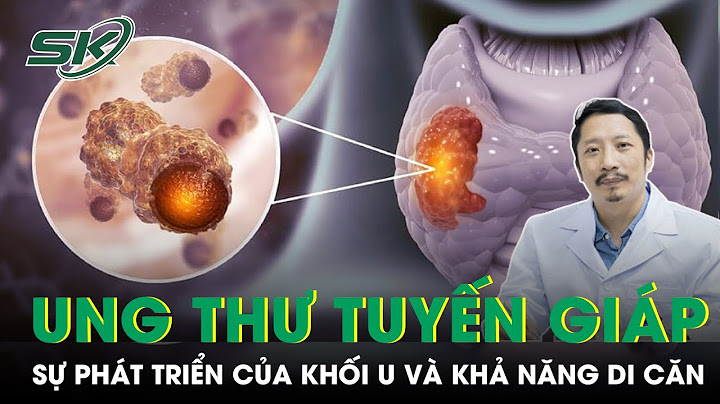 Hội chứng men 2b không thuộc loại ung thư nào năm 2024