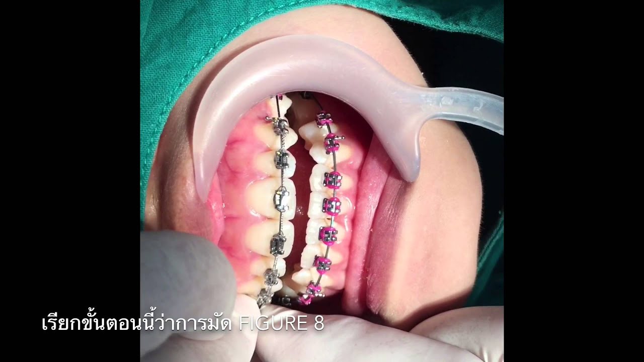 Ep.3 Figure 8 ligature wire YouTube