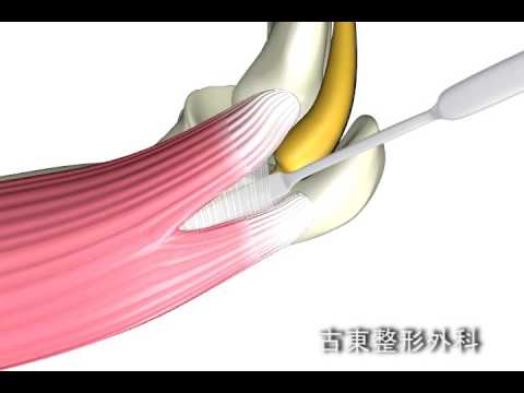 肘 部 管 症候群