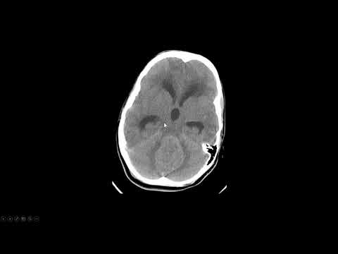 Vídeo: La Glucólisis Aeróbica Mediada Por Hexoquinasa-2 Es Parte Integral De La Neurogénesis Cerebelosa Y La Patogénesis Del Meduloblastoma