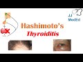 Hashimoto’s thyroiditis: What Is It, Who's At Risk and What You NEED to Know