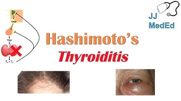 Hashimoto’s thyroiditis: What Is It, Who