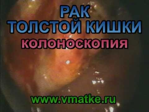 Рак толстой кишки. Колоноскопия.