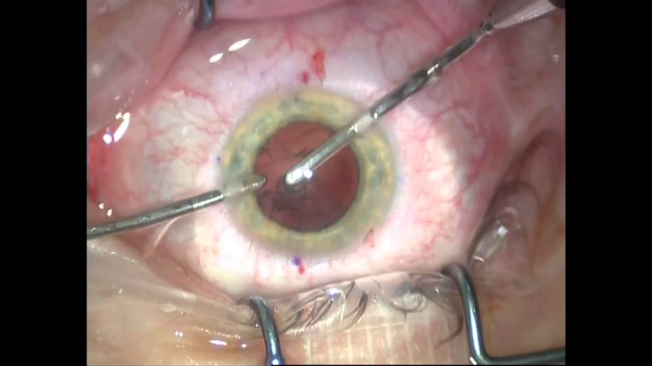 Факоэмульсификация катаракты