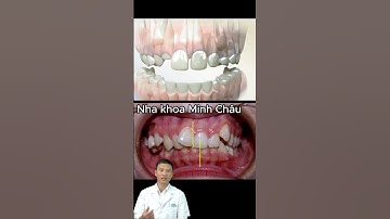 Tình Trạng Răng Lệch Đường Giữa?! | Bác Sĩ Yên